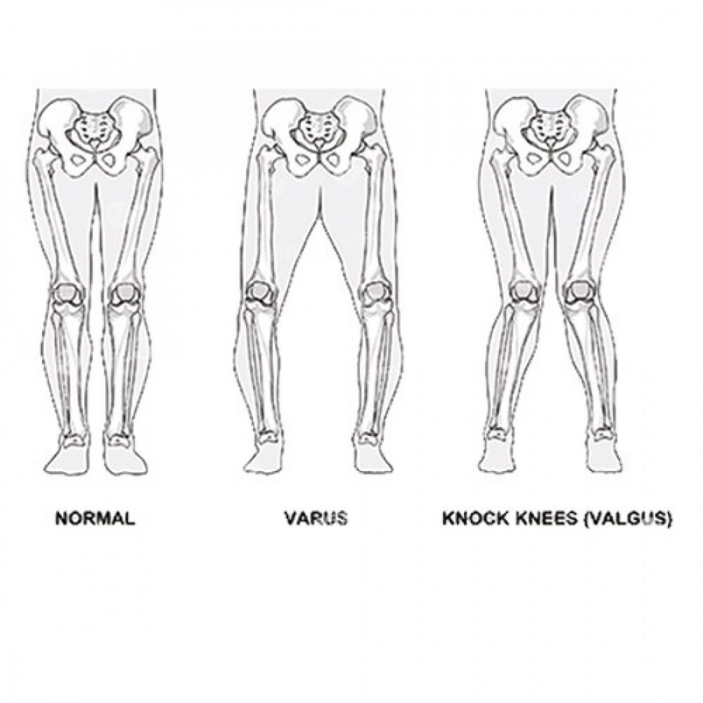 Νάρθηκας οστεοαρθρίτιδος γόνατος SPARTAN Ορθοπεδικά είδη