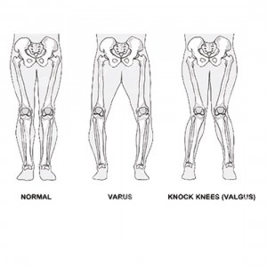 Νάρθηκας οστεοαρθρίτιδος γόνατος SPARTAN Ορθοπεδικά είδη